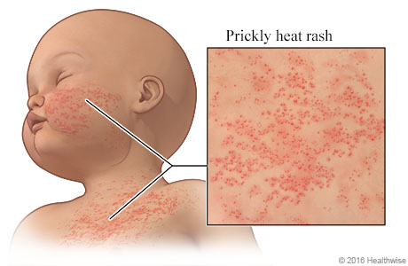 How to get rid of heat rash and prickly heat in children and adults -  signs, symptoms and treatment