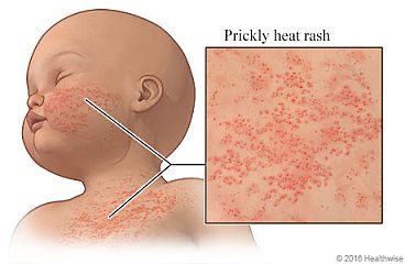 Heat rash on a baby's chest and cheek, with close-up of the rash