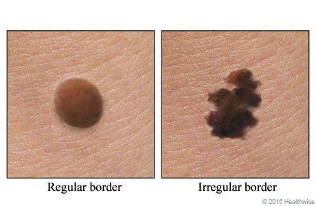 A normal mole and a mole with a ragged, notched border.