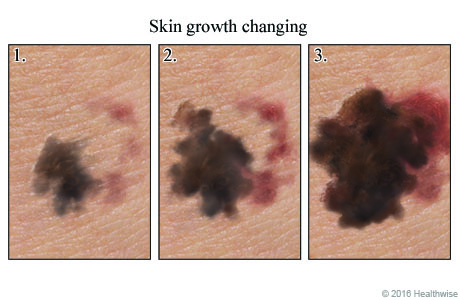 Three images that show a skin growth getting larger over time.
