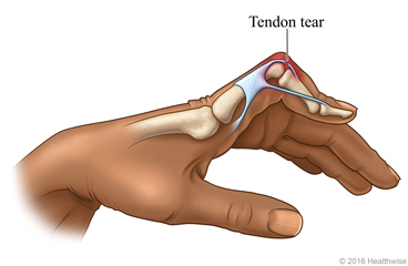 Bent finger caused by a tendon tear