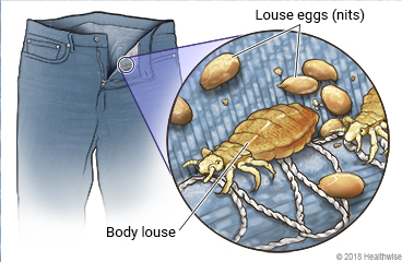 Body lice in pants seam, with close-up of louse and eggs (nits)