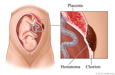 A fetus inside the uterus, with detail of a subchorionic hematoma