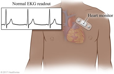 Adhesive patch heart monitor and normal EKG readout