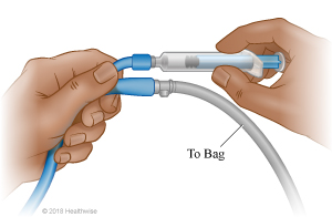 A Foley catheter has two ports: one for the urine bag and one to attach to the syringe for draining the balloon.