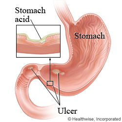 Ulcers in the stomach