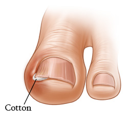 Picture of how to treat an ingrown toenail
