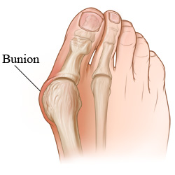 Skeletal view of a bunion