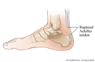 Picture of a ruptured Achilles tendon