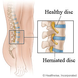 Healthy and herniated discs