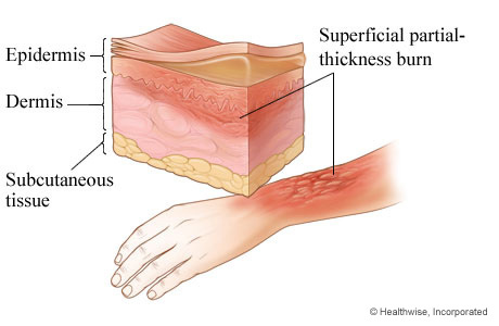 Second-degree burn: superficial partial-thickness burn.