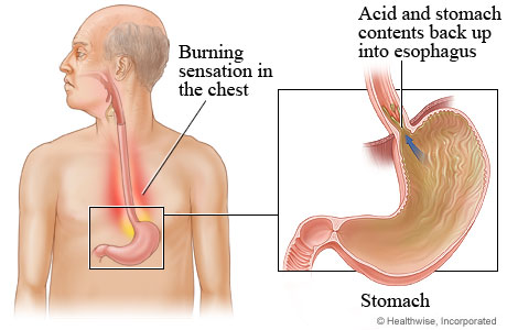 Location of stomach, with detail of acid backing up into esophagus.