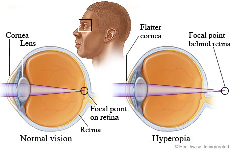 Cross sections of the eye for normal vision and for farsightedness.