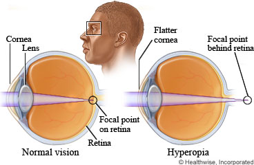Picture of eyes showing normal vision and farsightedness