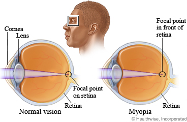 Picture of eyes showing normal vision and nearsightedness