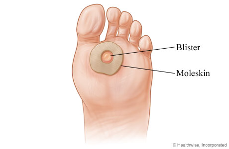 How to treat a blister.