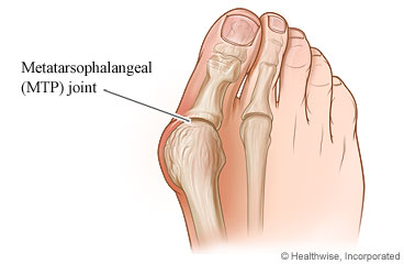 A foot with a bunion on the big toe joint