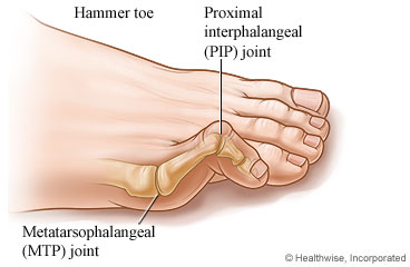 How to Treat Hammer Toes?