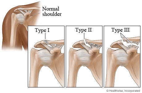 Type I, type II, and type III shoulder separation injuries.
