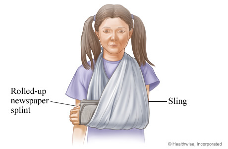 How to wear a splint or sling for an injured arm.