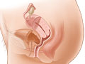 21 What is FemiCushion? ideas  pelvic organ prolapse, pelvic organ prolapse  symptoms, organs