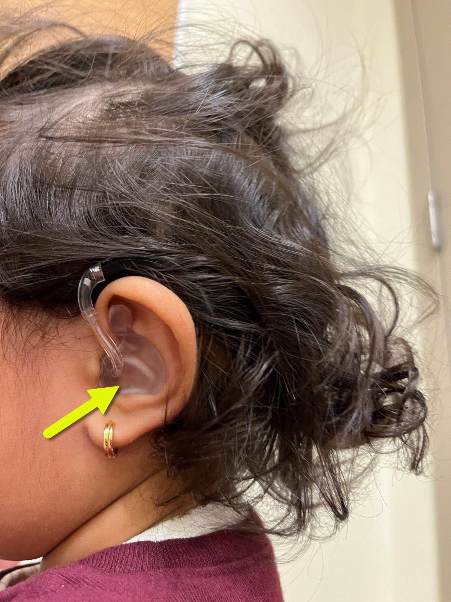 ear mold in child's ear