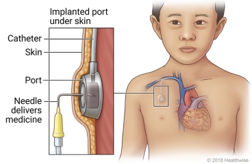 Location of an implanted port in the chest, with detail of the port under the skin