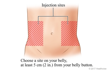 Injection sites, to either side and at least 5 centimetres (2 inches) from belly button.