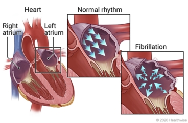 Right and left atria of heart, with details showing normal and fibrillation in an atrium.