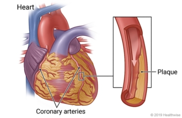 Heart showing two coronary arteries, with detail of artery narrowed by plaque.