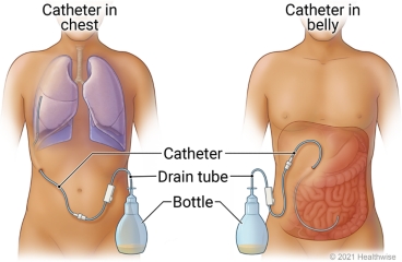 First image: catheter in chest, with tube connected to bottle to collect fluid; second image: catheter placed in belly, with tube connected to bottle to collect fluid.