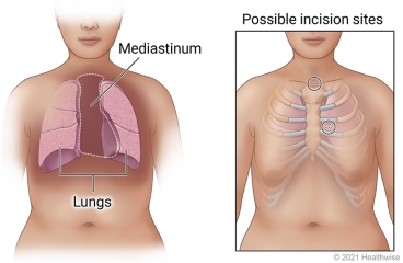 Lungs in chest and mediastinal space between lungs, with detail showing possible incision sites above or left of breastbone.