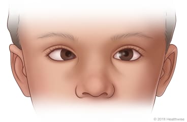 Child with right eye looking toward nose and left eye looking straight ahead.