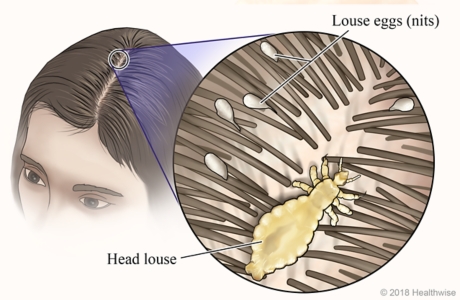 Lice in a person's hair part, with close-up of louse and louse eggs (nits).