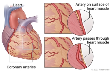 Coronary arteries on heart, with detail of artery on the surface of heart muscle and part of artery passing through heart muscle.