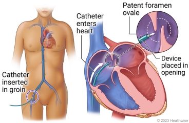 Catheter inserted in blood vessel near groin and into heart, with details showing patent foramen ovale and location where device will be placed.