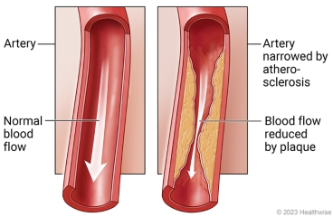Inside view of artery with normal blood flow compared to artery affected by atherosclerosis, with blood flow reduced by plaque.