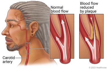 Carotid artery in neck, with detail comparing normal blood flow in artery and blood flow reduced by plaque.