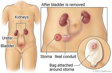 Kidneys, ureters, and bladder in lower belly, with detail of stoma and ileal conduit after bladder is removed, with bag attached to skin around stoma.