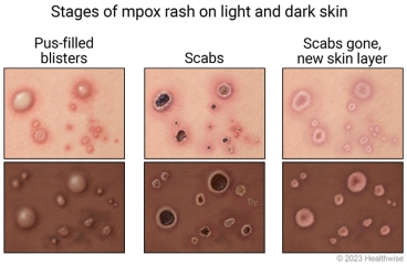 Stages of mpox on light and dark skin, showing pus-filled blisters, then scabs, and then scabs gone with a new skin layer as it heals.