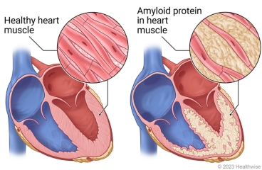 Heart showing healthy heart muscle and heart showing amyloid protein built up in heart muscle.