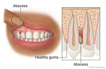 Mouth with abscess in tissue of gums, with detail of healthy gums and abscess in gums between two teeth.