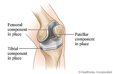 Picture of a knee replacement components