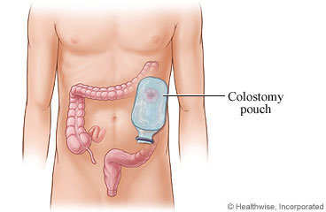 Picture of a colostomy pouch