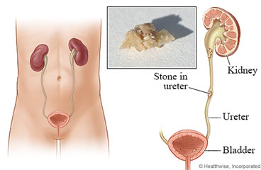 Picture of a kidney stone in the ureter