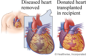 Picture of heart transplant