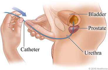 Gently insert catheter into urethra until urine flows