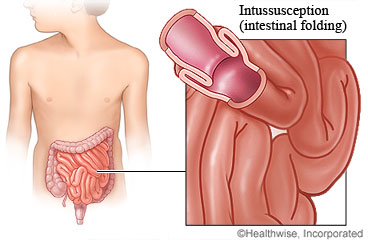 Picture of intussusception
