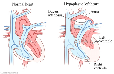 Normal heart and heart showing smaller aorta and smaller left ventricle (hypoplastic left heart) along with the ductus arteriosus