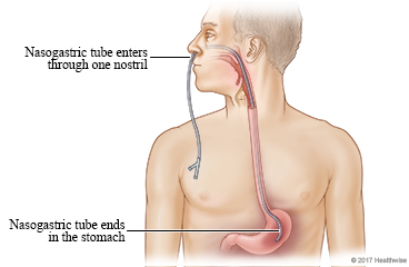 Nasogastric tube enters nostril, passes down through throat, and ends in stomach